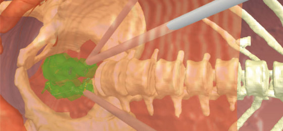 Patientenmodell, chirurgische Instrumente und Arbeitsraum der Instrumente (Quelle: Institut für Prozessrechentechnik, Automation und Robotik)